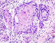 Image result for Cervical Cancer CT Scan