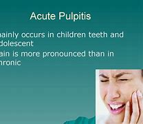 Image result for Pulpitis Tooth