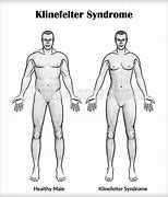 Image result for Klinefelter's Syndrome Diagnosis