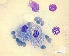 Image result for Gaucher Cell S
