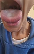 Image result for Strawberry Tongue Virus