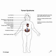 Image result for Turner Syndrome