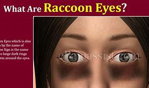 Image result for Battle Sign Raccoon Eyes