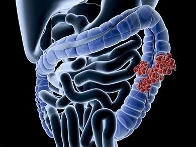 Image result for What is Colorectal Cancer
