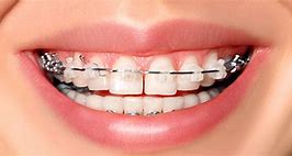 Image result for Ceramic and Metal Braces