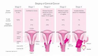 Image result for Stage 4 Cervical Cancer