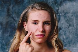Image result for Portraits with Blemishes