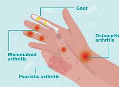 Image result for Arthritis Joint Pain