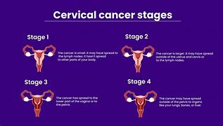 Image result for Metastatic Cervical Cancer Stage 4