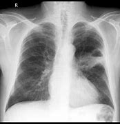 Image result for Stage 4 Lung Cancer Prognosis