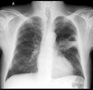 Image result for Stage 4 Lung Cancer Symptoms