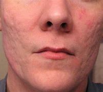 Image result for Deep Acne Scars