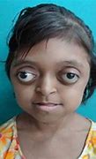 Image result for Crouzan Syndrome S