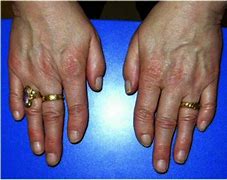 Image result for Feingold Syndrome