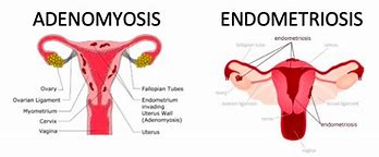 Image result for Endometriosis