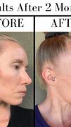 Image result for Vitamin C Serum Before and After