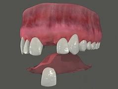 Image result for Flipper Dental Appliance