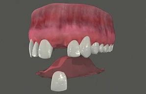 Image result for Upper Tooth Flipper