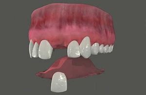 Image result for Front Tooth Flipper