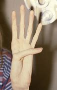 Image result for Marfan Syndrome Hands