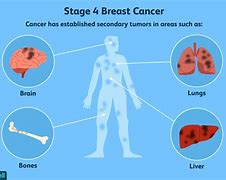 Image result for Stage 4 Lung Cancer in Bones