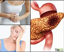 Image result for Signs of Pancreatic Cancer