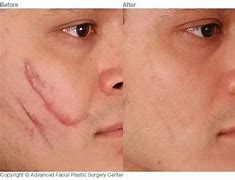 Image result for Nail Scratch Scar
