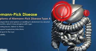 Image result for People with Niemann-Pick Disease