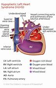 Image result for Hypoplastic Left Heart Diagram