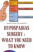 Image result for Side Effects of Hypospadias