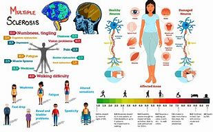 Image result for M and Multiple Sclerosis