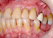 Image result for Dechaussement Des Dents