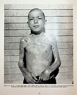 Image result for Japan Atomic Bomb Health Effects