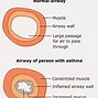 Image result for Asthma Chart