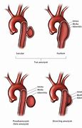 Image result for Aortic Aneurysm