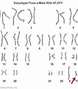 Image result for Jacobs Syndrome Karyotype