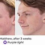 Image result for LED Light Therapy Before and After