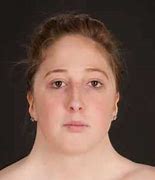 Image result for Female with Turner Syndrome