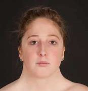 Image result for Female with Turner Syndrome