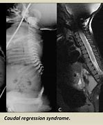 Image result for Caudal Regression Syndrome