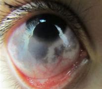 Image result for White Part of Eye