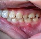 Image result for Dental Dent