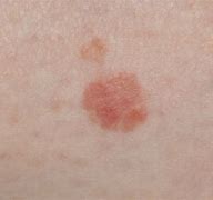 Image result for Blemish On Black Skin