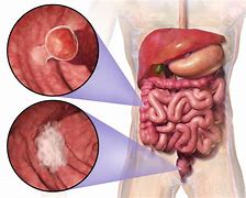 Image result for Symptoms of Stage 4 Colon Cancer