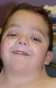 Image result for Noonan Syndrome