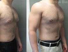 Image result for Male Gynecomastia