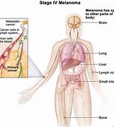 Image result for Malignant Melanoma Prognosis
