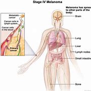 Image result for Melanoma Brain Cancer Prognosis