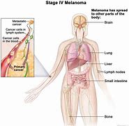 Image result for What Is Stage 4 Melanoma