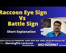 Image result for Concussion Raccoon Eyes